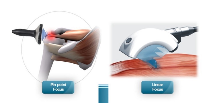 มหัศจรรย์แห่ง Focused Shock Wave | Rehab Care Clinic